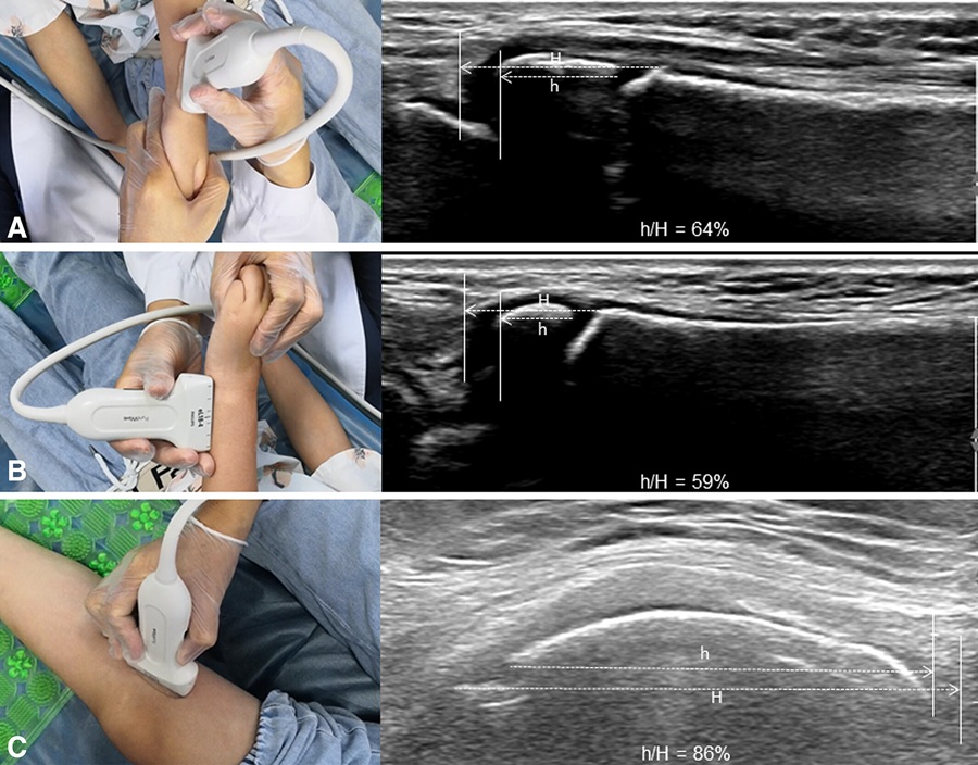 ultrasonic bone age