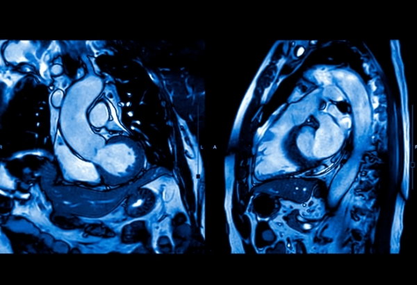Stress MRI: Η εξέταση που εντοπίζει στηθάγχη που διαφεύγει από την αγγειογραφία